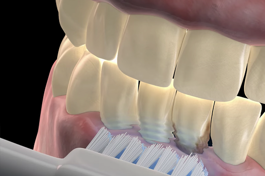 Los beneficios de tener una sonrisa limpia con ultrasonido